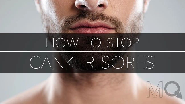 How to Stop Canker Sores