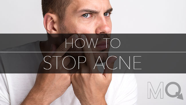 How to Get Better Skin and Stop Acne in its Tracks