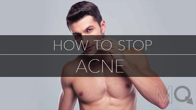 How to Stop Acne With This Simple Routine