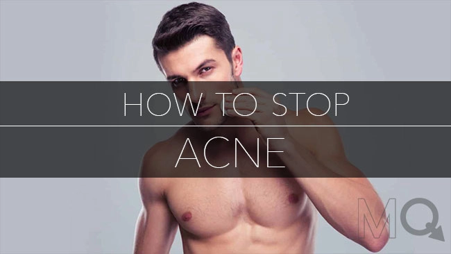 How to Stop Acne With This Simple Routine
